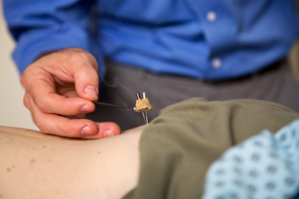 Moxa on inserted needles